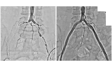 PADと静脈不全の原因は何ですか?