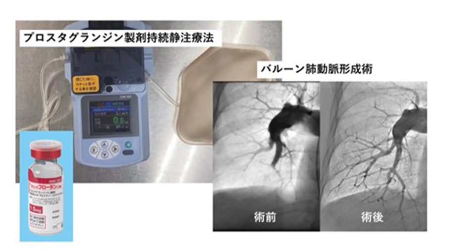 肺高血圧症の治療